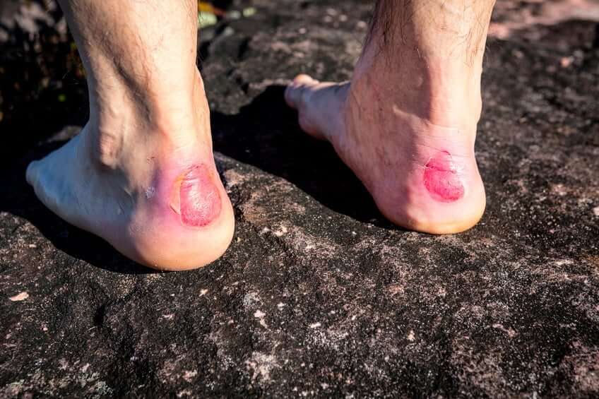 How to treat blisters