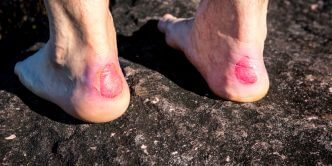 How to treat blisters